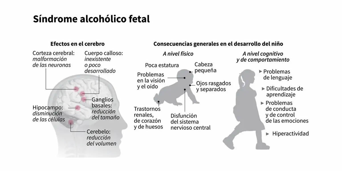 Sindrome Alcoholico Fetal
